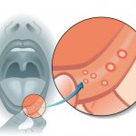 aphthous stomatitis – photo