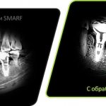 SMARF algorithm in Papaya 3D Genoray devices (South Korea)