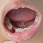 Alveolitis of tooth socket photo