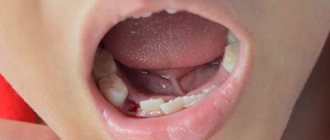 Alveolitis of tooth socket photo