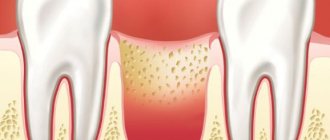 Alveolitis after tooth extraction - symptoms and treatment