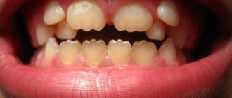 Anomalies in tooth shape, treatment and prevention