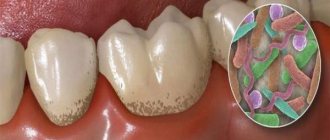 Bacteria on gums