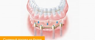 Beam fastening of removable dentures on implants in pictures