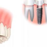 Базальная имплантация зубов
