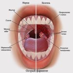 White spots in the throat: causes and treatment