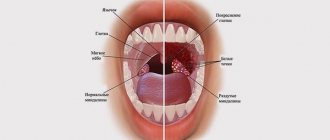 Белые точки в горле: причины и лечение