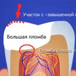 Болит зуб под пломбой - завышенная пломба