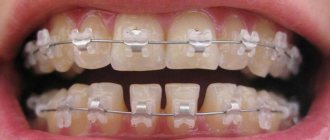 In-Ovation braces