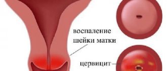 Cervicitis. Treatment in Moscow. 