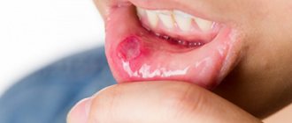 How to treat stomatitis