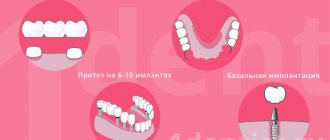 What can be put in place of an extracted tooth?