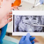 What you need to know before dental implantation