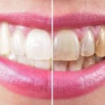 What is tooth pigmentation