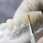 Zirconium dental prosthesis