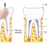 Депульпация зуба