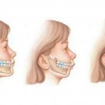 Distal bite - types