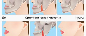 Before and after orthognathic surgery in pictures