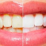 Endodontic teeth whitening