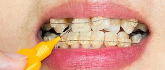 Brush - a friend of braces - Line of Smile Dentistry