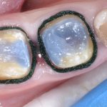 Этапы постановки ретракционной нити в стоматологии