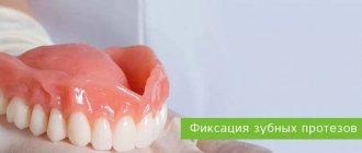 fixation of dentures