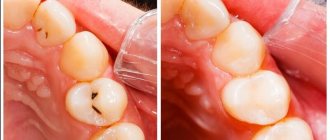 fissure caries treatment, diagnosis, prevention