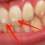 Dental fluorosis