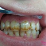 fluorosis