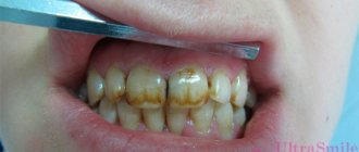 fluorosis