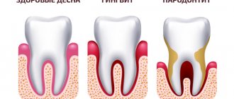 Photos of the stages of development of periodontitis in pictures