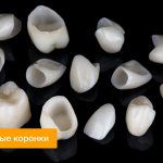 Photos of porcelain crowns