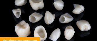 Photos of porcelain crowns