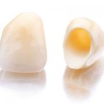 Photos of ceramic crowns