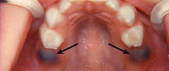 Photo of an eruption cyst in a child