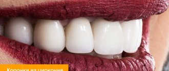 Photo of zirconium crowns on teeth