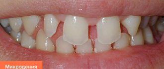 Photo of microdentia