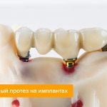 Photo of a bridge on implants