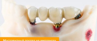 Photo of a bridge on implants