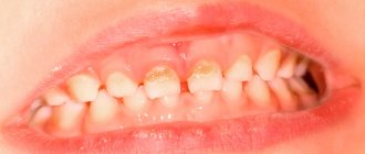 Фото начального кариеса молочных зубов