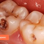 Photo of average caries of the seventh and sixth teeth