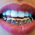 photo of grills installed on teeth