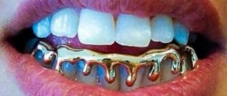 photo of grills installed on teeth