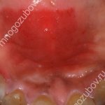 Photo: inflammation under a denture