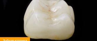 Photo of a dental crown