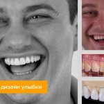 Photo of patient&#39;s teeth before and after digital smile design