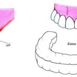 Teeth whitening gels and trays