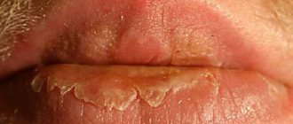 cheilitis