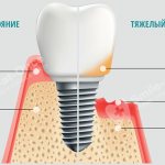 имплантация при пародонтите