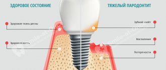 implantation for periodontitis